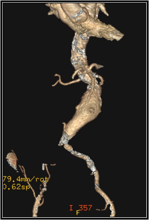 Preoperative 3-D reconstruction based on CTA imaging demonstrating an infrarenal abdominal aortic aneurysm and complete occlusion of the right common iliac artery with distal reconstitution.