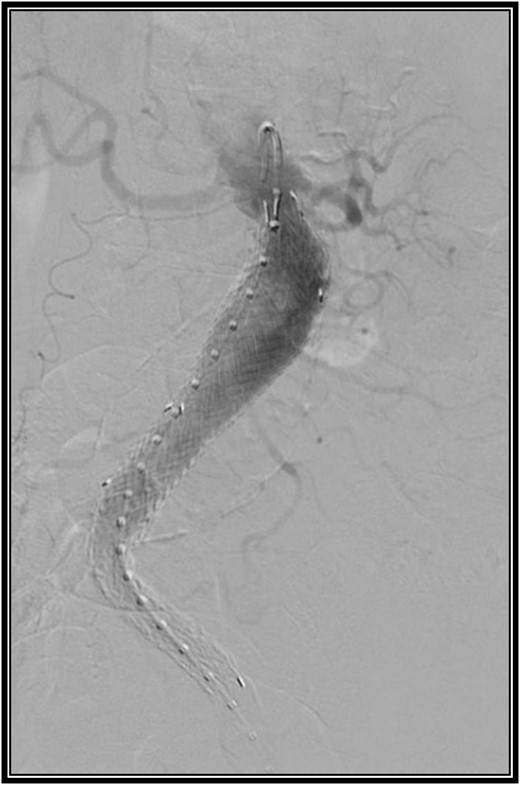 Intraoperative angiogram after placement of an aorto-uni-iliac stent graft.