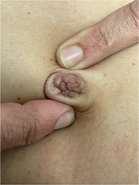 Umbilical endometriosis with suspicion of attachment to underlying rectus.