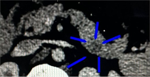 CT of the transverse plane of the pancreas revealed an ill-defined ovoid structure at the pancreatic tail tip.