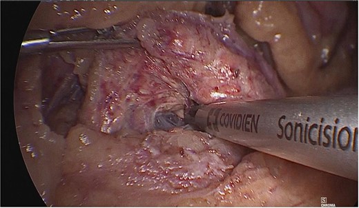A plane was created between the portal vein and the neck of the pancreas by blunt dissection.
