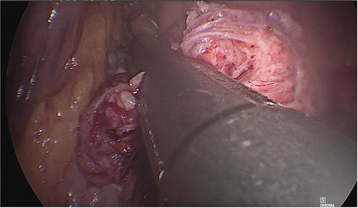 The neck of the pancreas was divided using an Endo GIA 60 mm endoscopic stapling device.