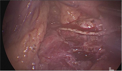 A second stapling was performed with an Endo GIA of 45 mm.