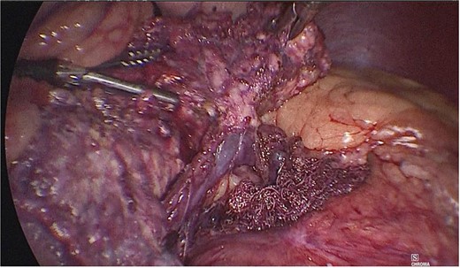 Dissection of the pancreas (body and tail) from splenic vascular structures (artery and vein).