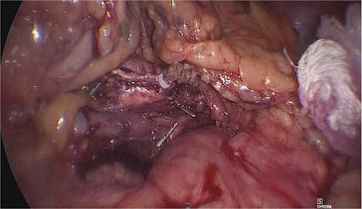 Extraction of the anatomical piece preserving vascular structures.