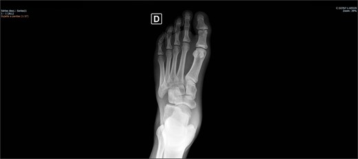 Preoperative X-ray of the foot in AP view