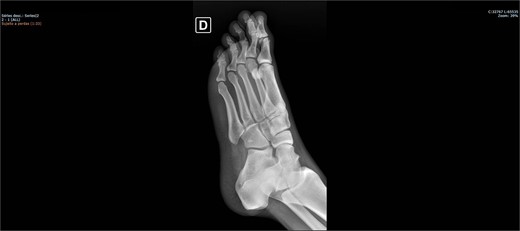 Preoperative X-ray of the foot in lateral view