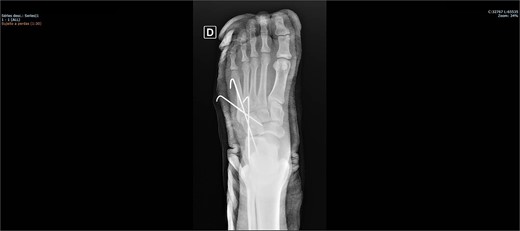 Postoperative X-ray of the foot in AP view