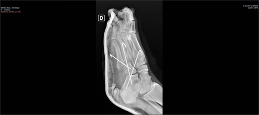 Postoperative X-ray of the foot in lateral view