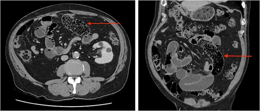 Abdominal CT scan axial (left) and coronal (right) images demonstrating ‘faecalization’ (arrow) of small bowel content.