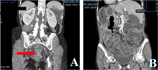 Abdomen and pelvis CT scan, coronal view (A) demonstrates low rectal concentric and symmetric near obstructing stricture indicated with the arrow. Coronal view (B) demonstrates a diffuse colonic and small bowel dilation consistent with LBO.