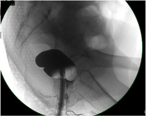 Contrast enema showing no retrograde filling due to low rectal stricture.
