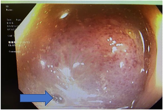 Colonoscopy showing bulky mass obscuring the lumen at 5 cm from the anal verge, blue arrow pointing at the miniscule lumen.