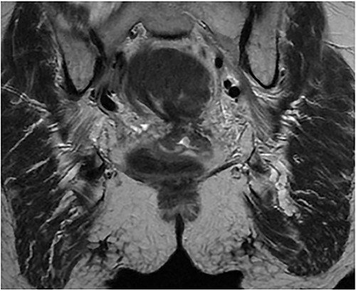 1.5 pelvis MRI, coronal view demonstrates apple core lesion at 5 cm from anal verge staged at T3N0 without involvement of anal sphincter.