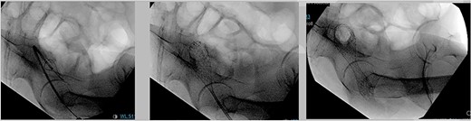Endoscopic 2.5 cm × 9 cm. Wall flex low rectal stent placement under fluoroscopy guidance.