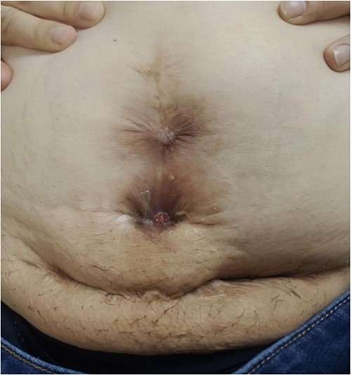 Purulent drainage at the inferior aspect of the vertical scar.