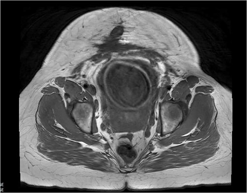 Abdominal MRI scan showing ventral wall defect.