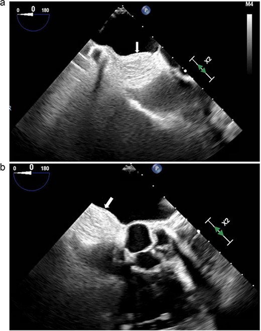 (a and b) Transesophageal echocardiogram. Arrow denotes mass involving the interatrial septum.