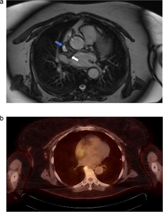 (a) Cardiac MRI. Mass is represented by the arrow on the right. The left arrow demonstrates the SVC. (b) PET/CT. Uptake is demonstrated in the right atrium. Uptake near the spine was determined to be artifact and not representative of metastatic disease.