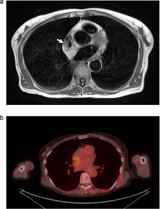 (a) MRI chest. Mass represented by white arrow. (b) PET/CT. Uptake is demonstrated in the mass associated with the SVC and right atrium.