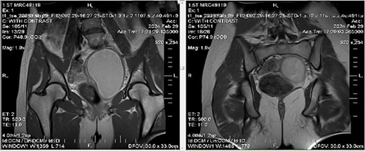 MRI imaging showing a big pelvic cystic hematoma measuring (7 cm × 12 cm × 6.7 cm) in the left paracentral position that extends close to the vaginal opening to the level of the right adnexa, encircled by a regular, thick wall that did not luminesce, and a relatively small myometrium with a regular endometrium.