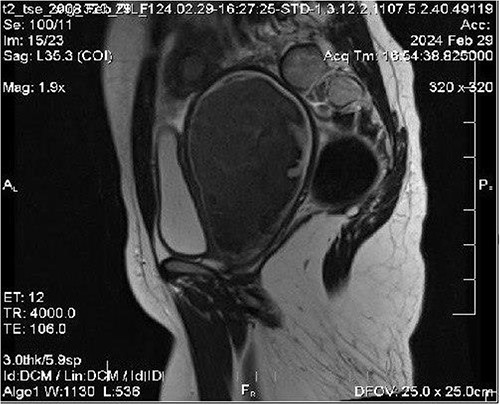 MRI imaging shows the level of vaginal obstruction.