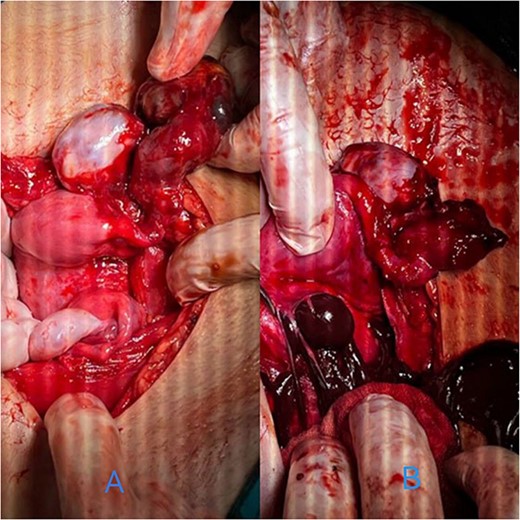(A) A hematoma in the left fallopian tube. (B) An accumulation of blood in the vagina.