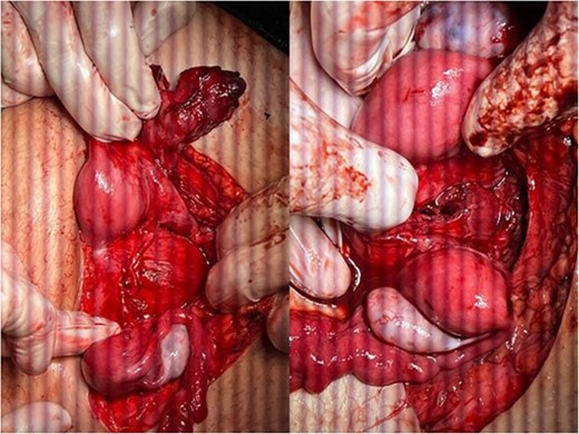 The didelphys uterus after the left fallopian tube and vaginal hematomas were drained.