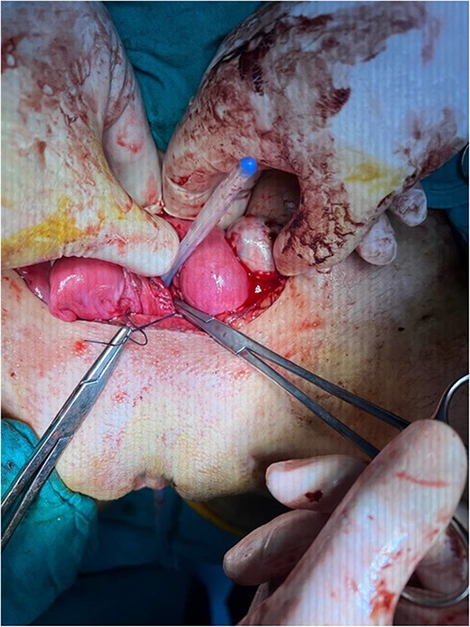 The silicon catheter placed trans-vaginally to reduce diaphragm recurrence and ensure adequate hematoma drainage.