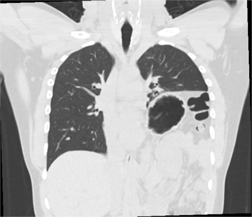 Pre-operative imaging revealing marked left diaphragm eventration.