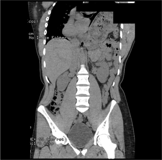 CT from 14-months pre-operation, demonstrating a full, but non-volvulized stomach.
