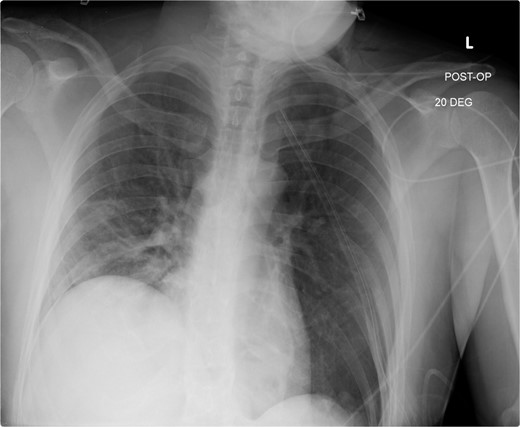 Immediate post-operative film demonstrates intact repair, and well-positioned chest-tube.