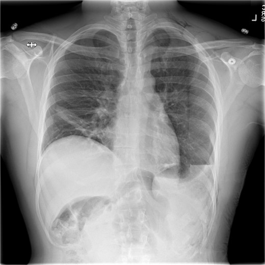 Following chest-tube removal, a film was taken, revealing even hemi-diaphragms, which was notably higher than immediate post-operatively, but within normal limits.
