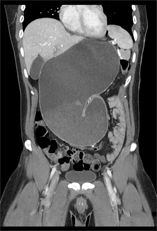 CT revealing intact diaphragm plication with massive organo-axial gastric volvulus.