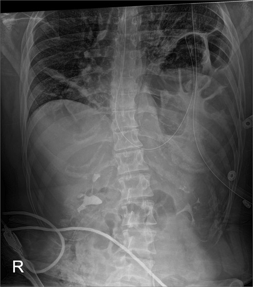 Confirmatory abdominal film for nasogastric tube placement demonstrating acute elevation in the left hemidiaphragm, 90-min after the CT, identifying the gastric volvulus.