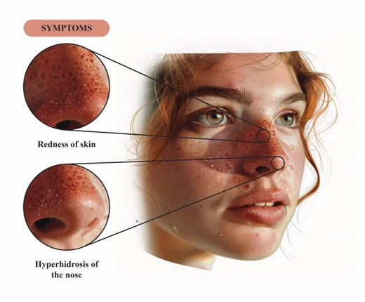 This figure provides an illustration of the clinical features of GRN; beads of sweat seen on an erythematous base over the nose.