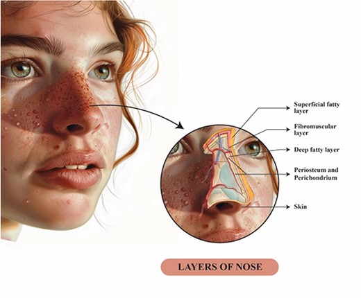 This illustration shows the anatomical soft tissue layers of the nose; during nasal flap elevation in open rhinoplasty, we believe that aggressive defatting and undercutting eccrine glands might cure granulosis rubra nasi.