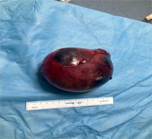 Postoperative specimen of Hematosalpinx side A.