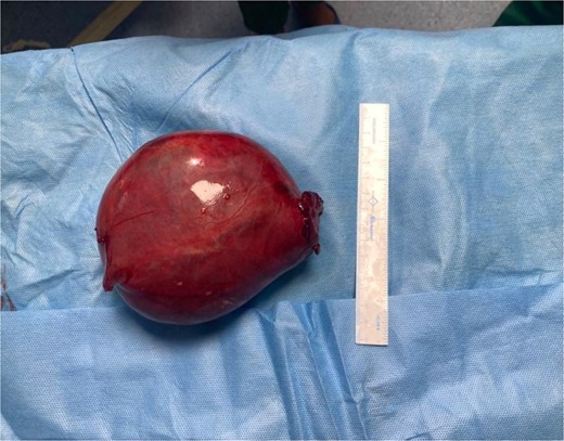 Postoperative specimen of Hematosalpinx side B.