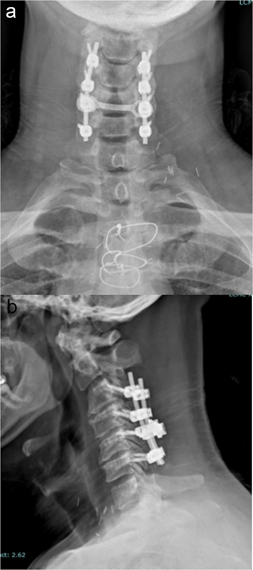Imaging showing the instrumentation used in a standard PCF. (a) AP X-rays of the cervical spine showing the lateral mass screws and rods inserted during a standard PCF. (b) Lateral X-rays of the cervical spine showing the lateral mass screws and rods inserted during a standard PCF.