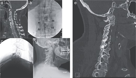 Imaging showing the minimally invasive interfacet cages technique. (a) Computer tomography imaging, sagittal view, showing lack of interbody fusion after ACDF 4-5-6. (b) AP intraoperative fluoroscopic images showing the placement of the interfacet cages. (c) Lateral intraoperative fluoroscopic images showing the placement of the interfacet cages. (d) Lateral X-ray showing a solid fusion at 1 year postoperatively. (e) Computer tomography imaging, sagittal view, showing a solid fusion at 1 year postoperatively.