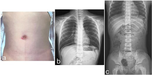 Physical and radiologic findings. (a) Abdominal photograph shows a bruise and redness at the umbilicus. (b) Upright chest X-ray shows free air in the right subdiaphragmatic region. (c) Supine abdominal X-ray shows no relevant findings.