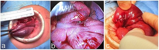 Intraoperative findings. (a) There is a perforation of the jejunum adjacent to the ligament of Treitz. (b) The perforation is temporarily sewn, and the intestine is returned to the abdominal cavity. Two intestinal serosal injuries are also noticed (white arrow). (c) Two intestinal serosal injuries are repaired, and the perforated portion of the intestine is resected and anastomosed.