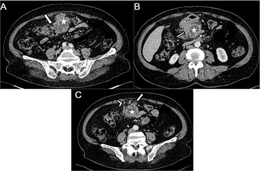 Axial sections of an abdominal CT showing (A) a heterogenous mesocolic mass (white star) infiltrating the transverse colon (White arrow), (B) the pre-pancreatic mass (white star) infiltrating the adjacent gastric wall (white arrow), (C) the mesecolic mass (white star) with stranding of the adjacent fat (white arrow) and satellite lymph nodes (white arrow head).