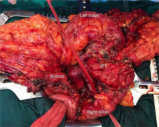 Operative view of the transverse colon tumor (IPT) after freeing the gastric antrum.