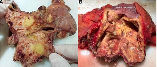Macroscopic view after section of the specimen showing a cysticized mass with a yellowish appearance (A) and extension to the colonic subserosa (B).