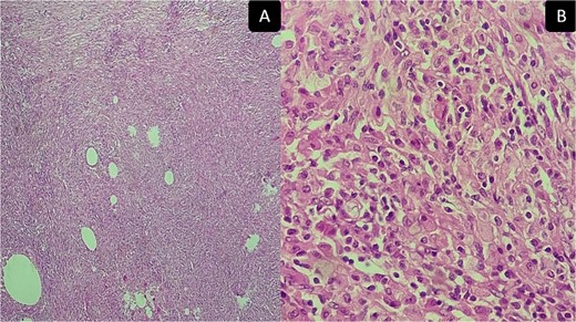 Inflammatory pseudotumor. Histological aspects: desmoid-type fibromatosis conventional pattern histological and immunohistochemical aspects: areas of histiocytes, and myofibroblasts, plasma cells, lymphocytes, and a few neutrophils and eosinophils. (A) Low magnification ×50 and (B) high magnification ×400.
