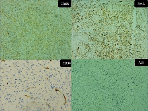 Inflammatory pseudotumor. Immunohistochemical aspects: (A) positive CD68 (original magnification ×50), (B) positive SMA (original magnification ×100), (C) negative CD34 (Original magnification ×200), and (D) negative ALK (original magnification ×50).
