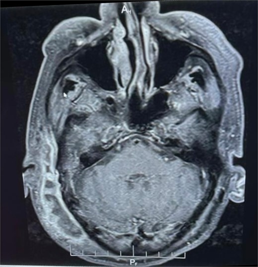 Enhanced MRI: Muitiloculated subcutaneous collection at the right temporoparietal region with marginal contrast enhancement, measuring ~0 cm x 2 cm. Marginally enhanced fluid collection on the right medial aspect of the nasopharynx.