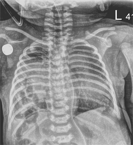 Chest X-ray, hour of life 1: there is a lucency in the right chest from the congenital diaphragmatic hernia as well as loops of bowel. There is no evidence of mediastinal shift and the superior aspect of the lung appears to aerate.